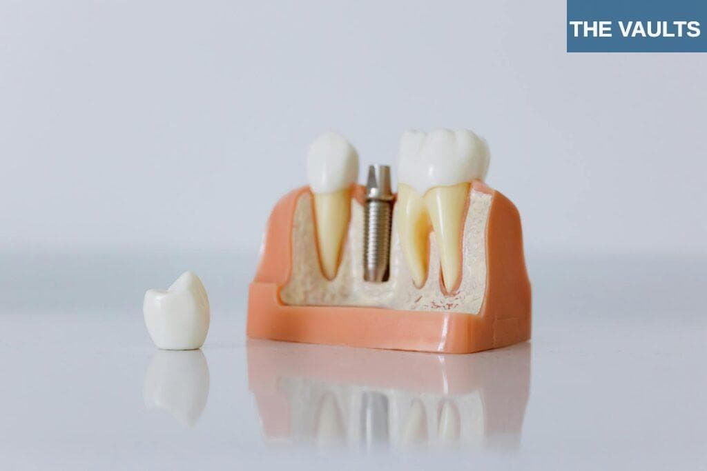 Close-up of a dental implant model featuring artificial teeth and jaw structure.